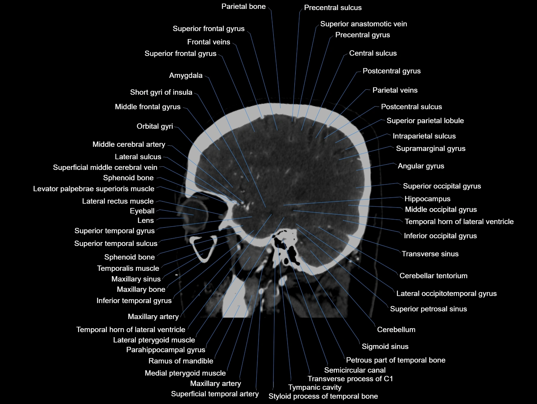 CT scan brain sagittal cross sectional anatomy image-img-00001-00022.webp